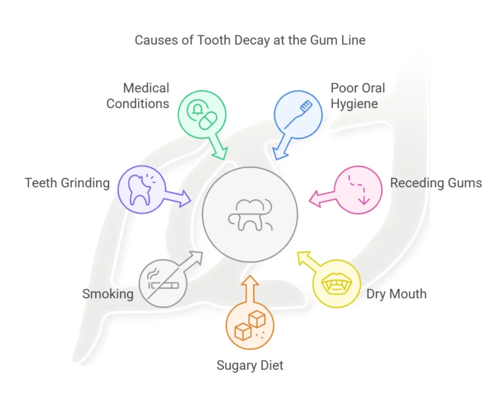Causes of Tooth Decay at the Gum Line