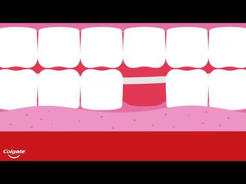 The Four Types of Dental Bridges